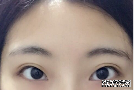 什么是間歇性外斜視，需要保健嗎